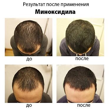 сыворотка для волос: Триоксидил 11% Сыворотка Для Роста Волос и бороды 50ml сыворотка 50 — 2