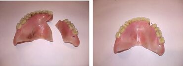 protez diş: Protez temiri. Maksimum 1 gun erzinde protezler temir olunur ve tehvil
