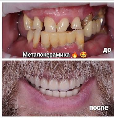 Стоматологи: Съёмные зубные протезы под ваши задачи - Вакуумные протезы: плотная — 15