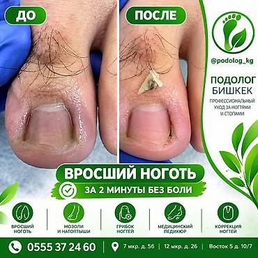ПОДОЛОГ БИШКЕК @podolog_kg 🦶 ВРОСШИЙ НОГОТЬ — УДАЛЕНИЕ ЗА 2 МИНУТЫ