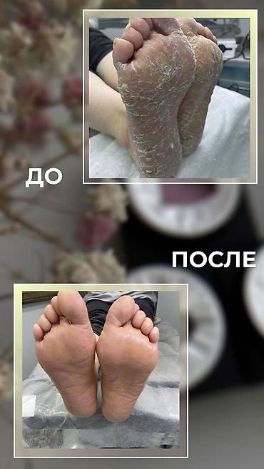 Сулуулук жана ден-соолук: Подолог, Бишкек, вросший ноготь, трещины на пятках, тырмак, грибок — 5