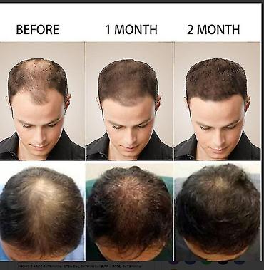 Уход за телом: США от облысения алопеции для роста волос продажа оптом и в розницу — 8