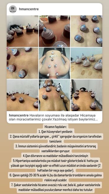 Hicama, zəli: Hicamanın Faydaları✅ *Qan dövranın pozulması *Qanın təmizlənməsi — 17