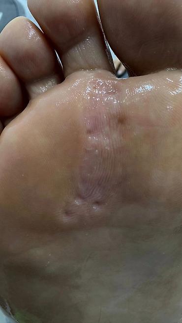 Маникюр: 📢акция с ! Вросший ноготь 📍подологический педикюр,👣 📍мозоли — 6