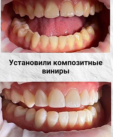 брекеты зубы: Клиника | Стоматолог | Протезирование — 7