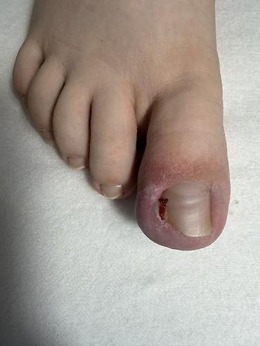 Маникюр: Коррекция вросших ногтей, Услуги подолога, Одноразовые расходные материалы — 8