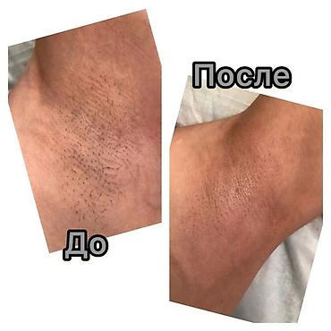 эпиляция шугаринг: Шугаринг подмышек Мастер с опытом работы принимаю на дому — 2