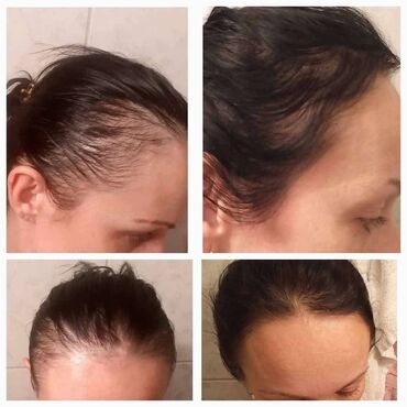 Nega kose: KosaLim 💚 Kosalim je kombinacija prirodnih ekstrakta lekovitog bilja na lalafo.rs — 1 Nega kose: KosaLim 💚 Kosalim je kombinacija prirodnih ekstrakta lekovitog bilja — 1