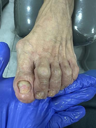 Маникюр: 📢акция с ! Вросший ноготь 📍подологический педикюр,👣 📍мозоли — 9