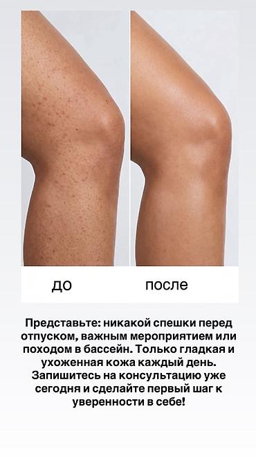 кт легких бишкек: 🏥 Лазерная эпиляция в клинике УмБем 🔥🔥🔥🔥🔥Все тело 3999 📍 Ош/ Ош — 3
