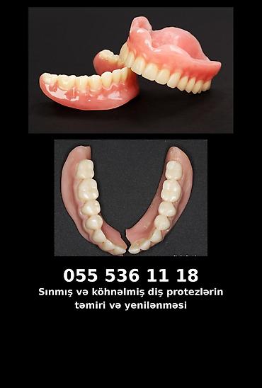 Услуги: Xidmət: Sınmış və köhnəlmiş diş protezlərinin təmiri və yenilənməsi — 1