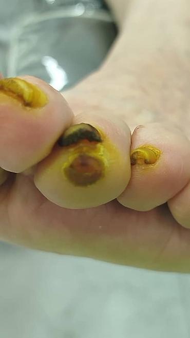 Маникюр: 📢акция с ! Вросший ноготь 📍подологический педикюр,👣 📍мозоли — 3