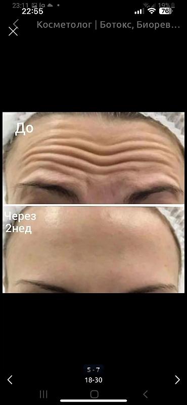 Косметология: Косметология, Ботокс, Биоревитализация, Ботулинотерапия, Консультация, Гипоаллергенные материалы, Сертифицированный косметолог at lalafo.kg — 29 Косметология: Косметология, Ботокс, Биоревитализация, Ботулинотерапия, Консультация, Гипоаллергенные материалы, Сертифицированный косметолог — 29