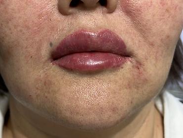 Косметология: Косметология, Увеличение губ, Гипоаллергенные материалы at lalafo.kg — 33 Косметология: Косметология, Увеличение губ, Гипоаллергенные материалы — 33