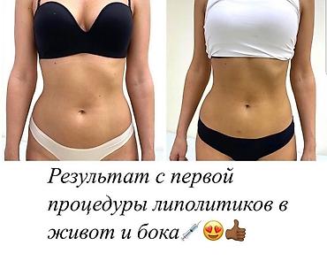 Косметология: Липолитики для проблемных зон. Похудение с первой процедуры. Всё виды — 3