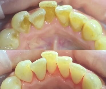 художественная реставрация зубов композитными материалами: Адрес: Бишкек, проспект Жибек-Жолу, 215 Чистка 3х этапная 1500 сом