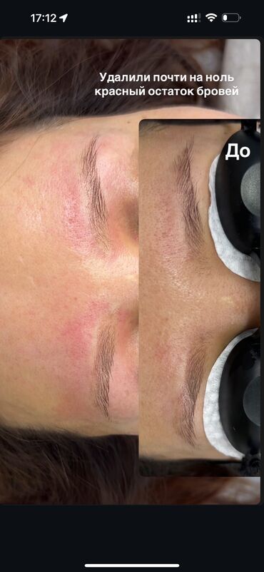 Перманентный макияж: АКЦИЯ !АКЦИЯ! Новый метод удаления Сейчас по акции Лазерное удаление — 16
