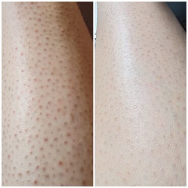 📸 Pre i posle – samo 7 dana! Ovo je rezultat kupke Aloe Body Wash i
