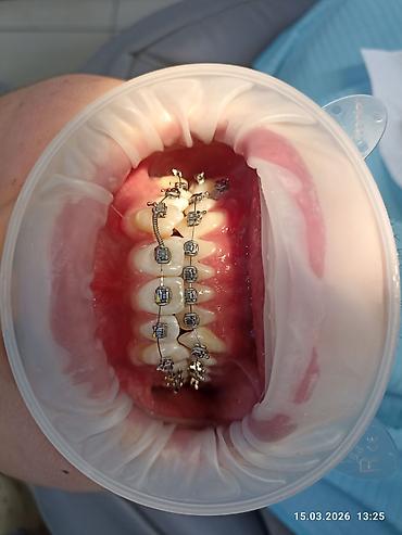 Ортезы: Ортодонтическое лечение: установка брекет‑системы на нижнюю челюсть - — 2