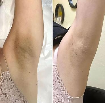 qara rəng: Alora Beauty – qaralıq və ləkələrə qarşı qabıqlanma effekti ilə baxım — 1