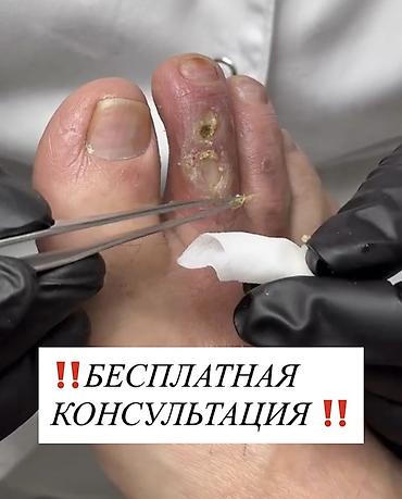 Ичине кирип өскөн тырмактарды оңдоо, Подолог кызматтары, Консультация lalafo.kg да Ичине кирип өскөн тырмактарды оңдоо, Подолог кызматтары, Консультация