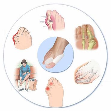 ортопедические товары для ног: Корректоры для большого пальца ноги от вальгусной деформации(косточки