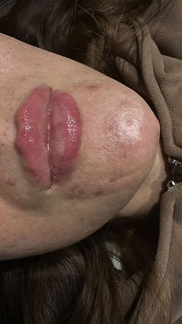 Косметология: Косметология, Увеличение губ, Гипоаллергенные материалы at lalafo.kg — 3 Косметология: Косметология, Увеличение губ, Гипоаллергенные материалы — 3