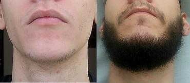 delay spray: Minoxidil 5%. Миноксидил. Оригинал. США. Первое средство для — 2