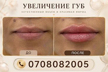 Контурная пластика губ гиалуроновым филлером. - Цель: увеличение