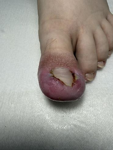 Маникюр: Коррекция вросших ногтей, Услуги подолога, Одноразовые расходные материалы — 4