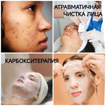 хиджама кровопускание: Атравматическая чистка лица + карбокситерапия
