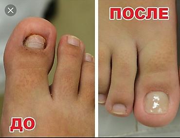 Красота и здоровье: Подолог бишкек вросший ноготь Медицинский педикюр, обработка любой — 2