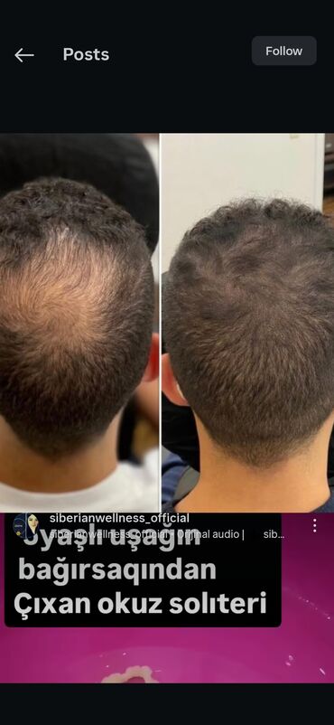 Saçlara qulluq: Saç üçün yağ, Saç tökülməsinə qarşı — 3