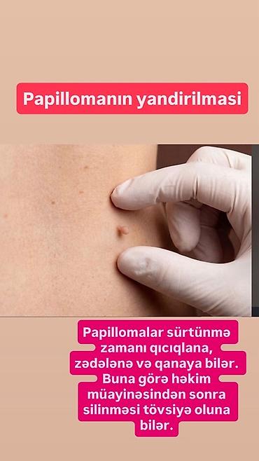 Xidmət: Papillomaların yandırılması (aradan qaldırılması) Təsvir: - lalafo.az -da Xidmət: Papillomaların yandırılması (aradan qaldırılması) Təsvir: -