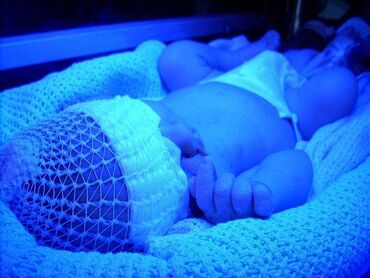 фотолампа от желтушки для новорожденных: Аренда лампы для лечения желтухи новорожденных. Медицинская лампа для