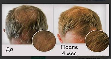 для роста волос: АППАРАТ ОТ ОБЛЫСЕНИЯ И НЕ ТОЛЬКО МНОГО ВИДОВ ВСЕ В ТЕМЕ читаем — 6