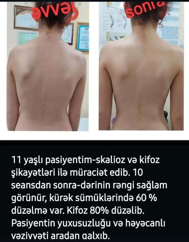 Tavalar: Skolioz masajı, Uşaqlar üçün