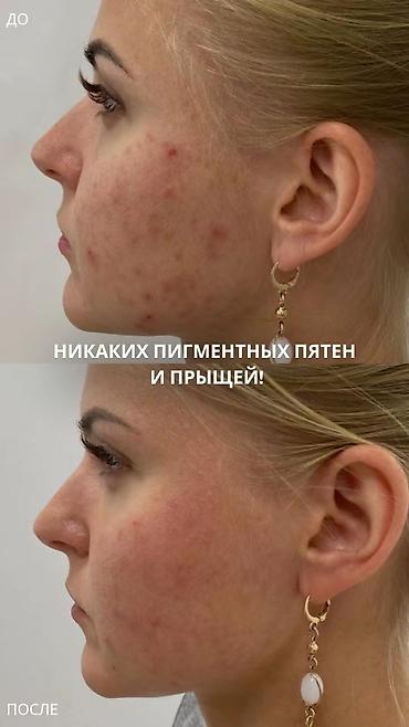 Косметология: Косметология, Пилинг, Демодекоз, Лифтинг, Консультация, Сертифицированный косметолог, Гипоаллергенные материалы — 14