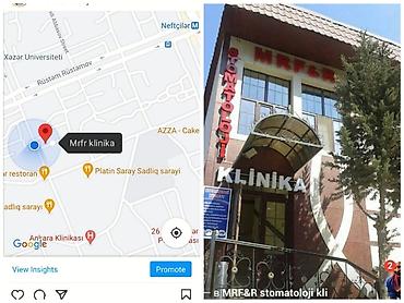 сколько стоят брекеты в баку: İnstaqram dr.zerif). Seçilən pasientlerə sonda kappa hədiyyə — 7