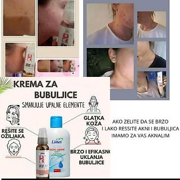 Nega kože: Aknelim gel 30ml – 100% delotvoran saveznik protiv akni Iskoristite — 10