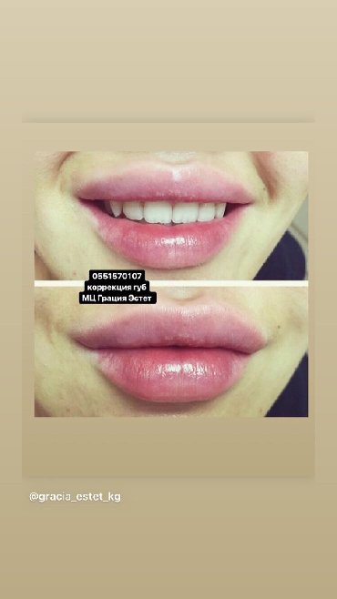 пермамент губ: Увеличенте губ, контурная пластика губ, скул, носа подбородка