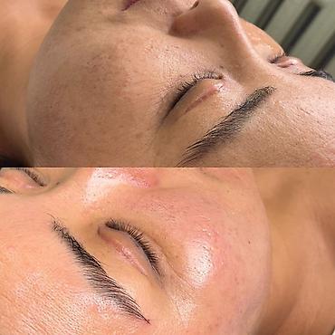 Косметология: Косметология, Чистка кожи, Массаж лица, Лечение угревой болезни, С выездом на дом, Сертифицированный косметолог, Консультация — 2