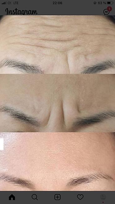 Косметология: Косметология, Ботокс, Биоревитализация, Ботулинотерапия, С выездом на дом, Консультация, Гипоаллергенные материалы — 8