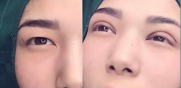 Косметология: Жип менен сурма чыгарабыз, операциясыз, кесилбейт, Оорубайт, шрам — 4