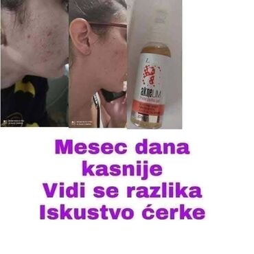 Nega kože: Aknelim gel 30ml – 100% delotvoran saveznik protiv akni Iskoristite — 4