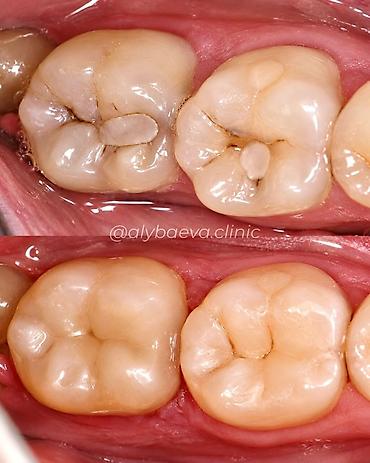 Сулуулук жана ден-соолук: Стоматология Dr. Alybaeva dental clinic Услуги: - Лечение без боли - — 5