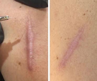 cərrahi: Keloid çapıqları(əməliyyat izləri) Əməliyyat izlərinin kompleks — 1