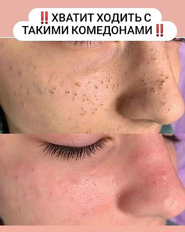 Косметология: Косметология, Чистка кожи, Массаж лица, Лечение угревой болезни, С выездом на дом, Сертифицированный косметолог, Консультация — 6