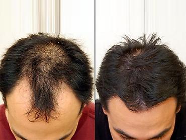 delay spray: Minoxidil 5%. Миноксидил. Оригинал. США. Первое средство для — 3