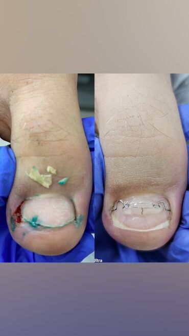 вросшие ногти: Педикюр | Коррекция вросших ногтей | Консультация, Одноразовые расходные материалы